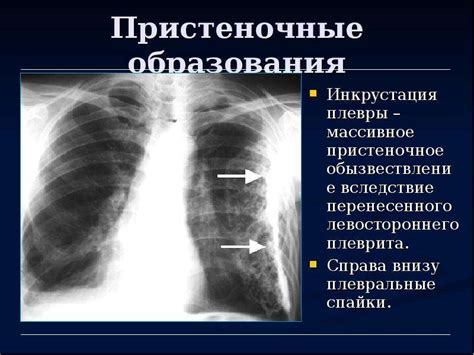 Важность междолевой плевры справа