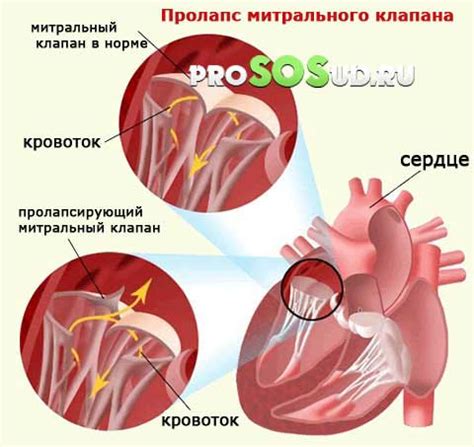 Влияние митрального клапана противофазы на работу сердца