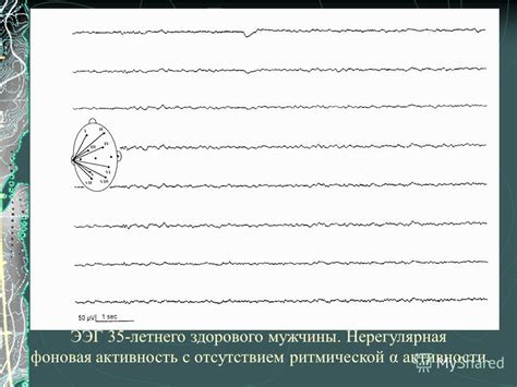 Дезорганизованная фоновая активность ЭЭГ: определение и причины