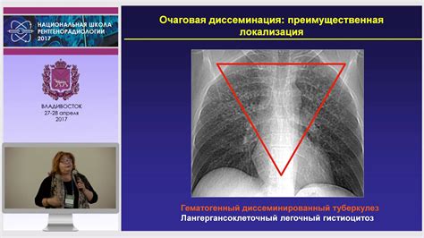 Диагностика выпадения легких