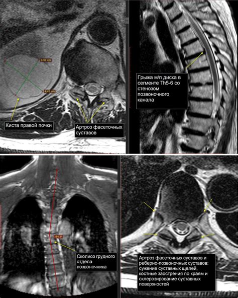 Диагностика дегенеративно-дистрофических изменений грудного отдела позвоночника