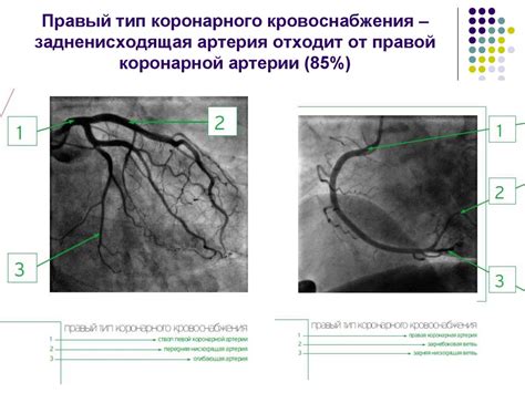 Диагностика правого типа коронарного кровоснабжения