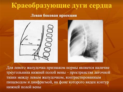 Диагностика удлинения дуги левого желудочка