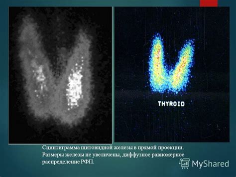 Диффузное распределение РФП