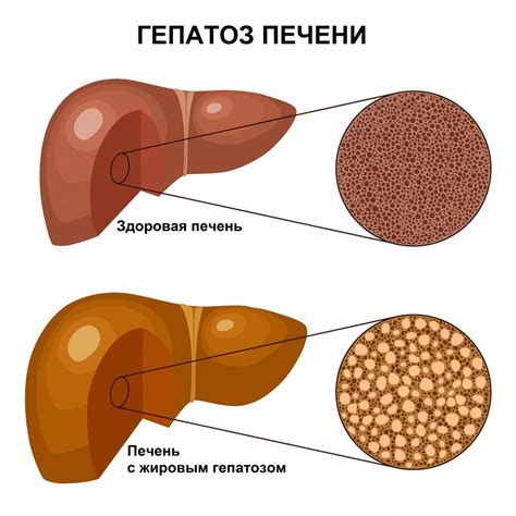 Жировая болезнь печени