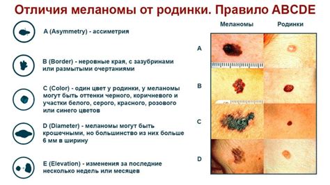 Значение родинки сердцем для здоровья