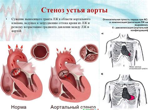 Клапанные заболевания сердца