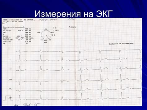 Клиническое значение увеличенной PTFV1 на ЭКГ