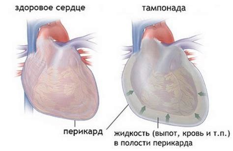 Лечение и профилактика расширения тени сердца