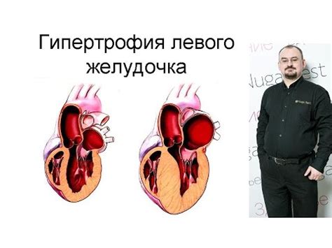 Лечение удлиненной дуги левого желудочка