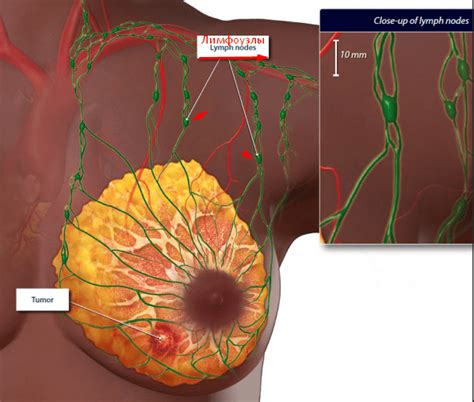 Лимфоузлы при маммографии