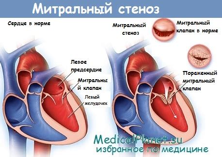 Митральный клапан противофаза: особенности и функции