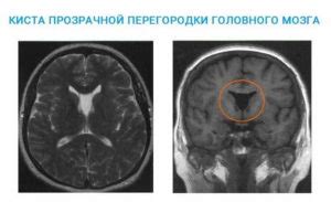 Незаращение листков прозрачной перегородки головного мозга: