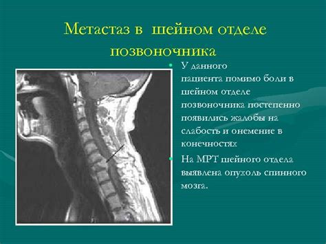 Означение данного явления в шейном отделе позвоночника