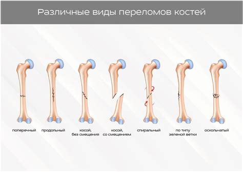 Особенности и симптомы частичного прослеживания линии перелома