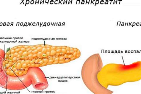 Патологии и экранирование хвоста поджелудочной железы