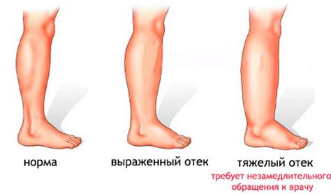 Почему возникает отек левой стороны тела: основные причины