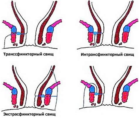 Причины возникновения эпителиального образования прямой кишки