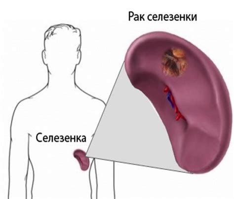 Причины несовершенного развития селезенки