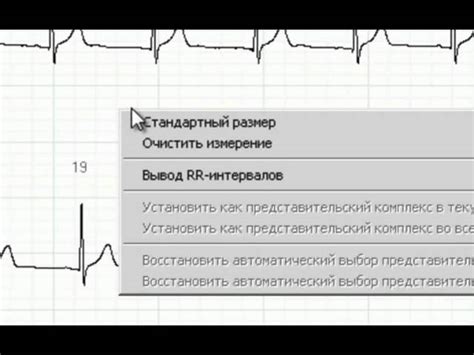 Причины низкоамплитудной ЭКГ