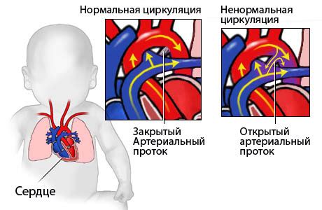 Причины поворота сердца у ребенка