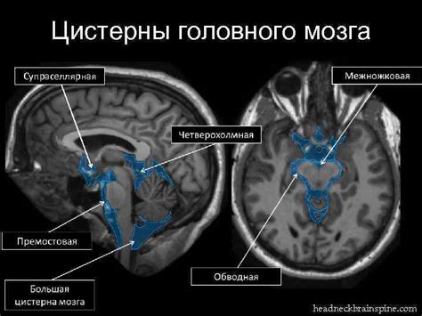 Причины увеличения цистерны мозга