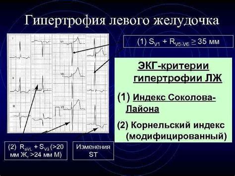 Причины удлинения дуги левого желудочка