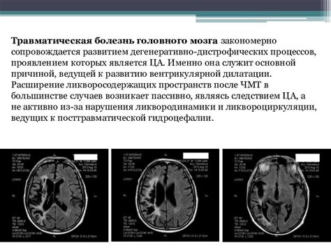 Причины церебральной атрофии GCA 1