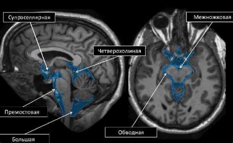 Профилактика увеличения цистерны мозга