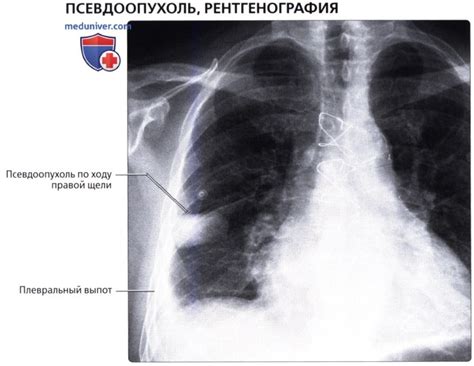 Профилактика утолщения костальной плевры