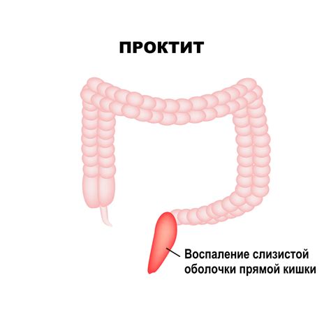 Процедуры при лечении очаговой гиперплазии слизистой прямой кишки