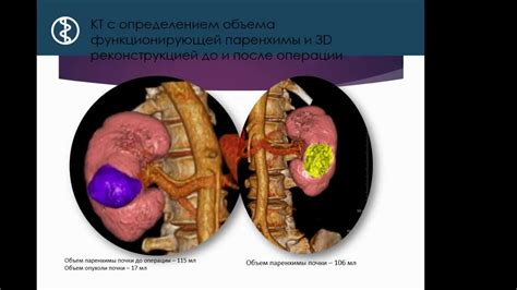 Разрушение паренхимы почки у женщин