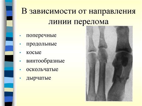 Раскрытие понятия: частичное прослеживание линии перелома