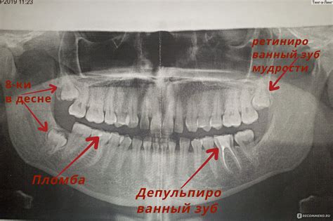 Расшифровка онкошифра