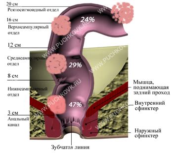 Симптомы и диагностика эпителиального образования прямой кишки