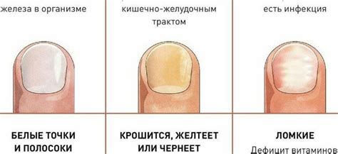 Симптомы перепиленной ногтевой пластины