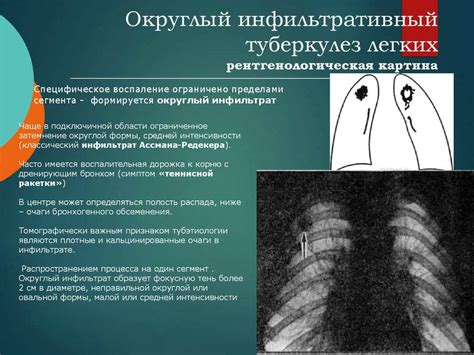 Симптомы периваскулярной инфильтрации легких