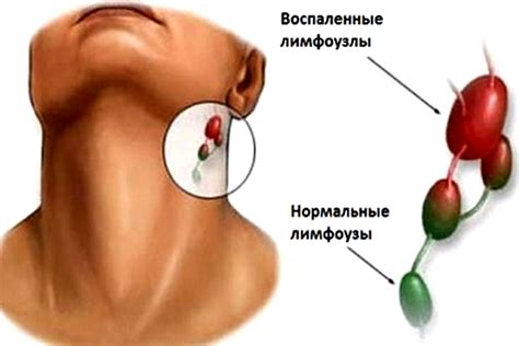 Симптомы поражения ретрокруральных лимфоузлов