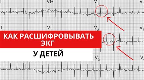 Симптомы ювенильного типа экг у ребенка