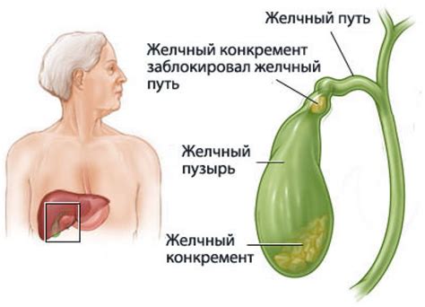 Содержимое желчного пузыря: причины неоднородности и возможные последствия