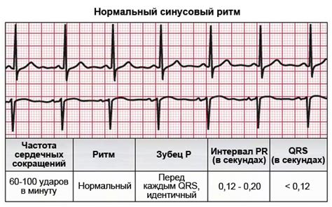 Характеристики увеличенной PTFV1 на ЭКГ