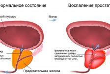 Что такое очаговая гиперплазия слизистой прямой кишки