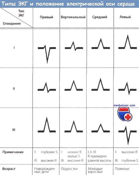 ЭКГ при повороте сердца левым желудочком вперед